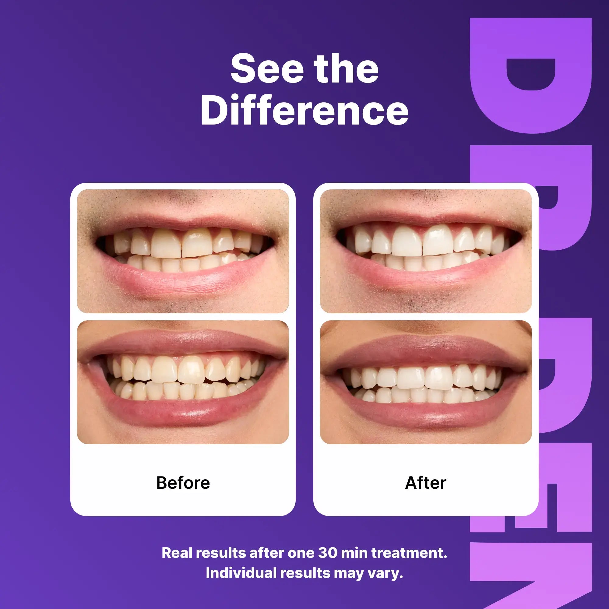 DRDENT Purple Oral Teeth Whitening Strips - 7/21 Sessions - Gentle Non-Sensitive, Peroxide-Free, Radiant Teeth Whitening Solution